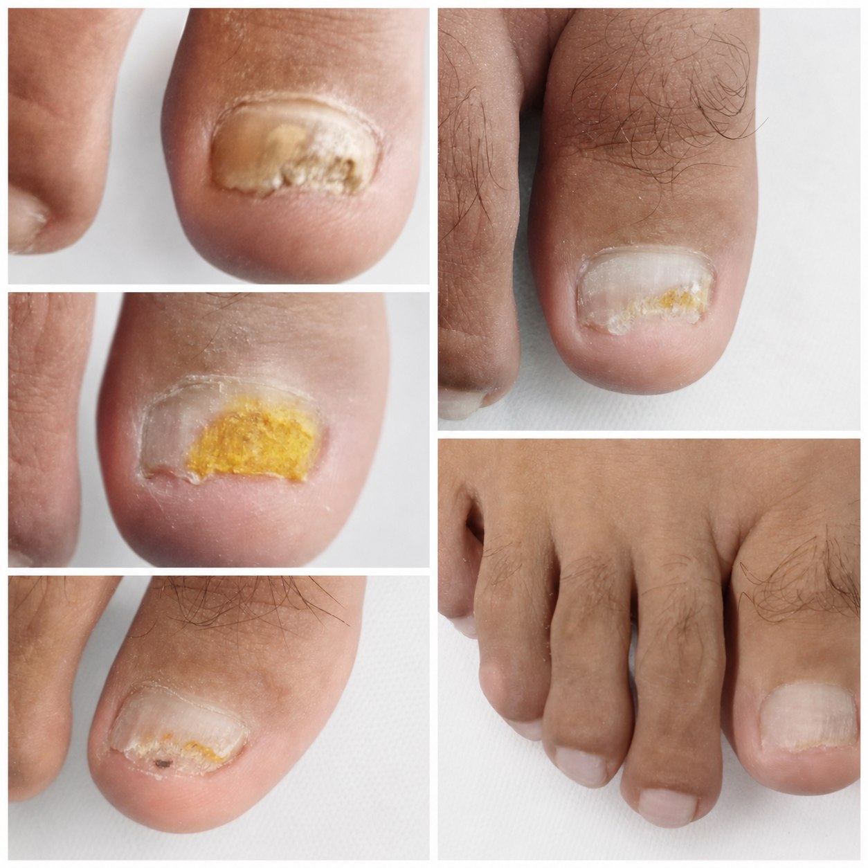 Evolución de tratamiento podológico para onicomicosis
